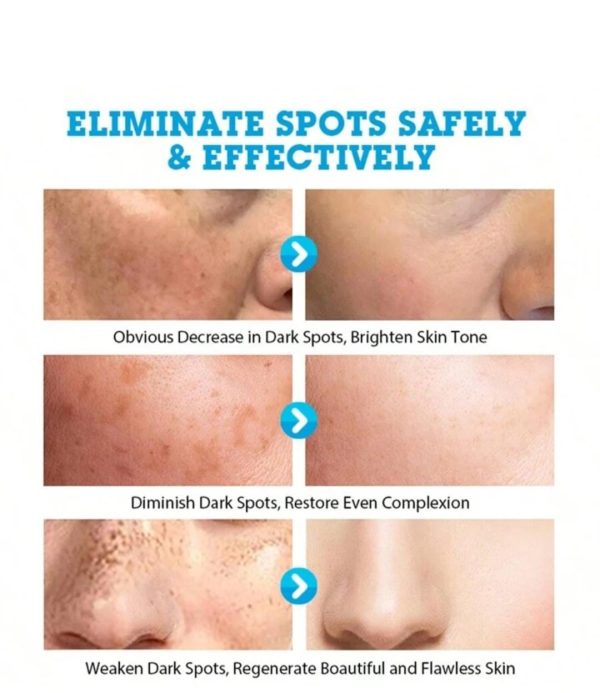 Mestin Anti-sun Spot Essence 30ml – Corrects Hyperpigmentation, Fades Dark Spots, Evens Skin Tone, 100% Natural Ingredients, Delays Aging